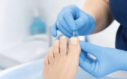 Podiatrist applying a thin composite Onyfix brace to a curved big toenail