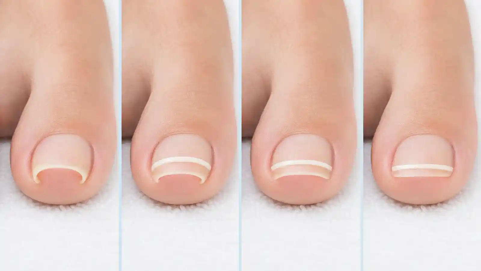 Four-stage illustration of a curved toenail gradually becoming flatter while supported by a thin composite correction strip