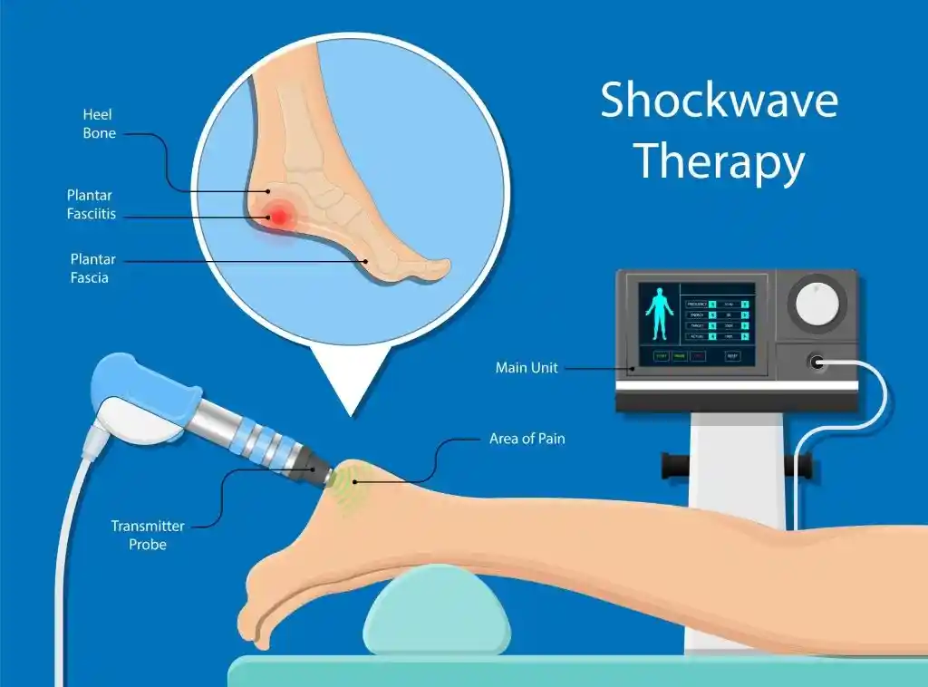 Shockwave therapy diagram showing the treatment unit, transmitter probe, plantar fascia, and area of heel pain